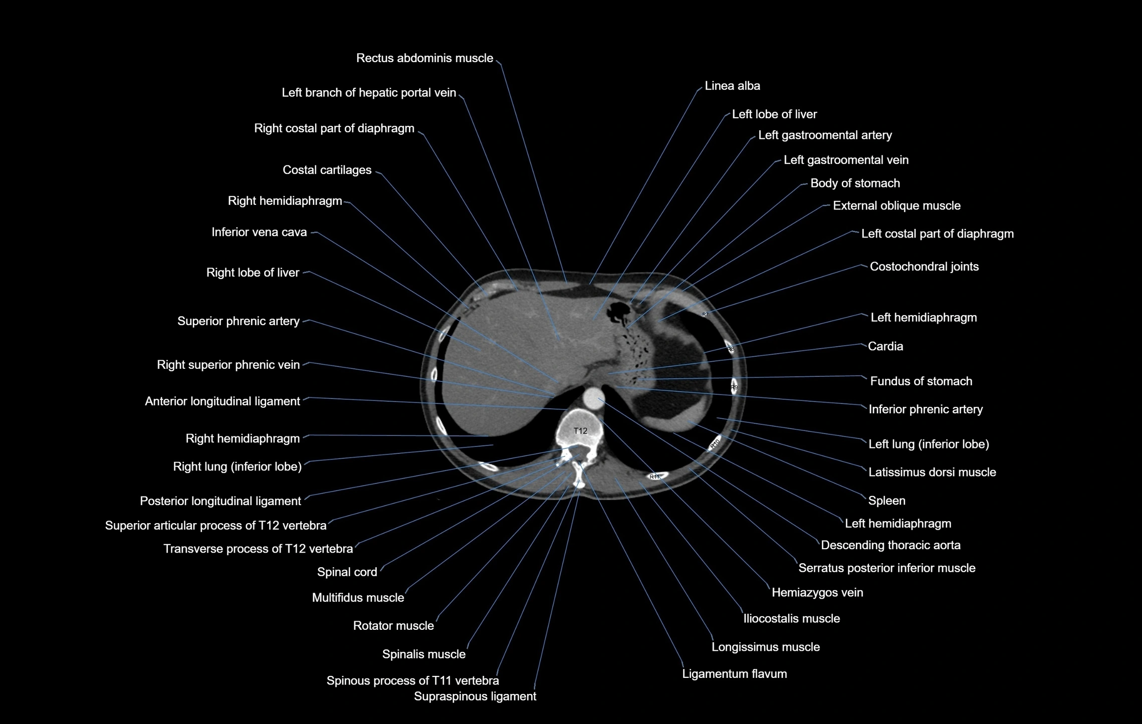 CT chest (thorax) labelled axial cross sectional anatomy radiology image-00108.webp